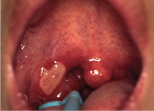 F9: Major apthous ulcer on the tonsilar fossa