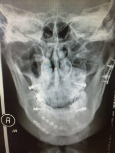 F9: Post-op PA mandible image of RIGHT parasymphysis and LEFT condyle mandible fractures following open reduction and internal fixation with titanium mini plates