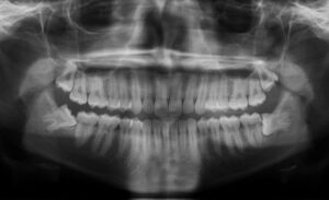 F9: OPG image of impacted wisdom teeth